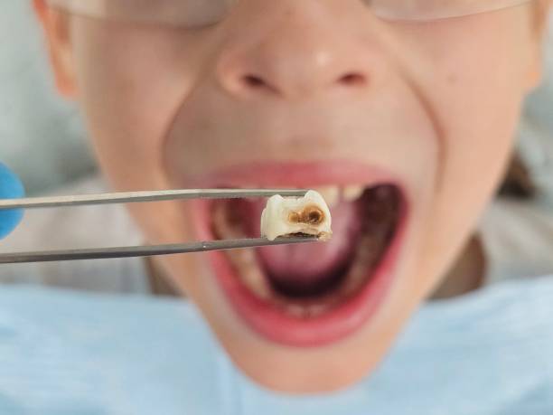 Best Emergency Wisdom Tooth Extraction in Woburn, MA